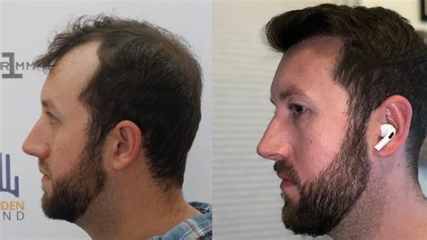 12 month post op. Before and after. : r/Hairtransplant .